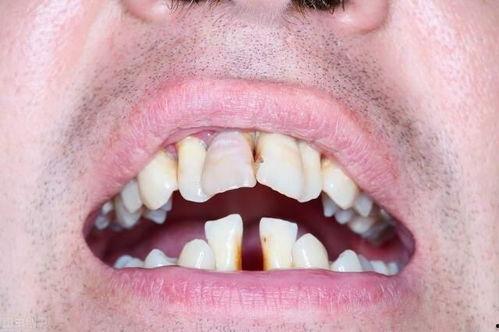 吃石头瓜牙齿酸软